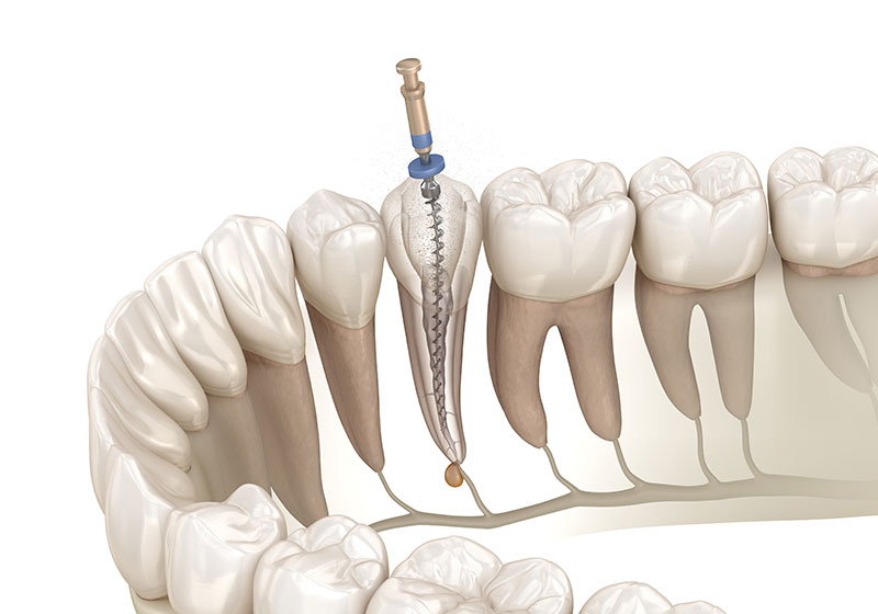 重度に進行した虫歯でも、根管治療でできるだけ歯を残します