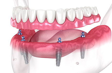 2～4本のインプラントで総入れ歯を固定する「インプラントオーバーデンチャー」